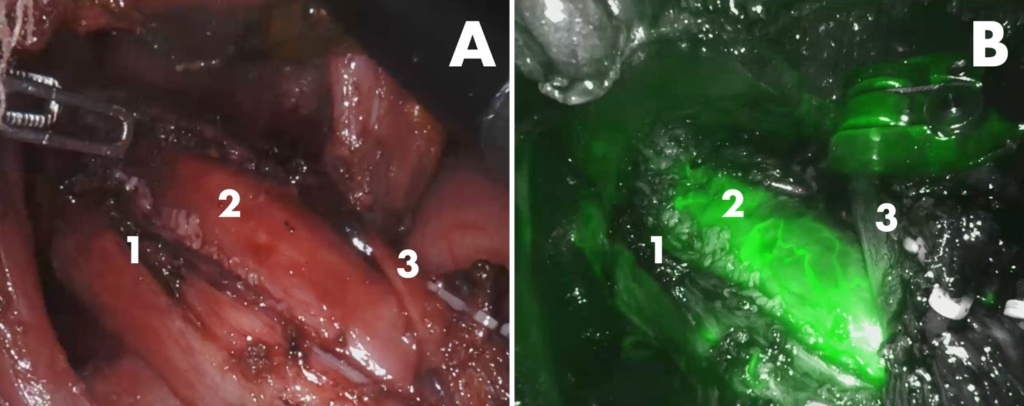 Figura 1 - Immagine intraoperatoria al termine della miotomia: A – luce bianca: 1. Margine della miotomia; 2. Mucosa esofagea; 3. Nervo vago anteriore. B – luce infrarosso con ICG (verde di indocianina): 1. Margine della miotomia; 2. Mucosa esofagea (visibili i vasi e la diffusione del colorante nel tessuto mucoso; 3. Nervo vago anteriore.